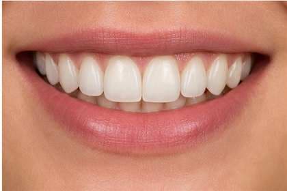 Patient smile before and after clear aligner therapy