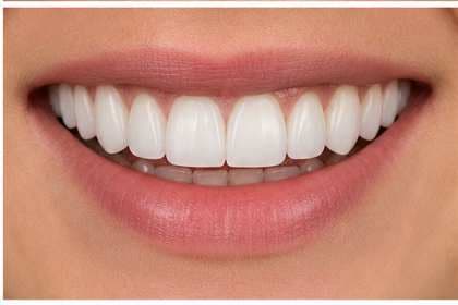 Patient smile before and after porcelain veneer treatment