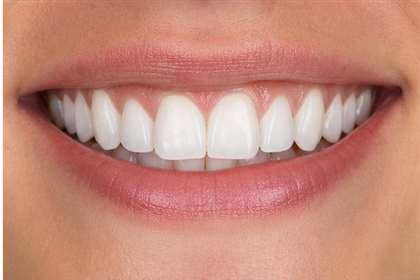 Patient smile before and after professional teeth whitening